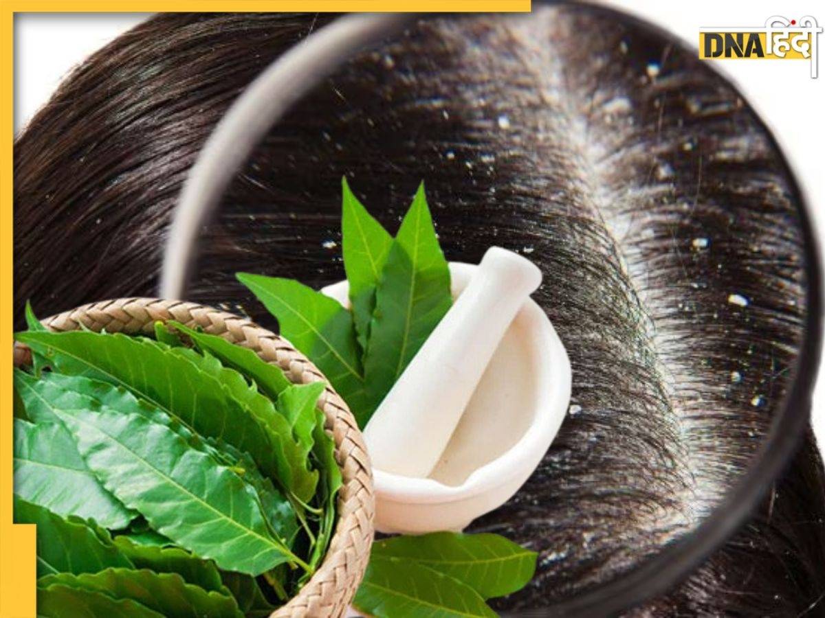 Dandruff Remedies: मिल गया डैंड्रफ का रामबाण इलाज, 4 तरह से इस्तेमाल करें नीम की पत्तियां, कभी नहीं होगी रूसी