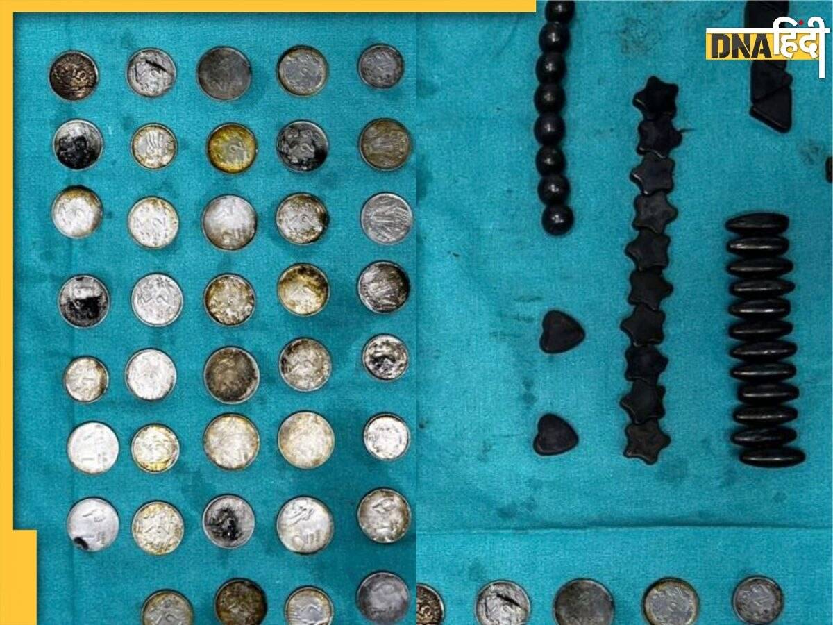 शरीर में जिंक की कमी पूरी करने के लिए खा रहा था Coin, पेट से निकले 39 सिक्के और 37 चुंबक