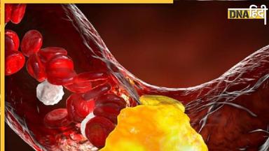 Cholesterol Alert: नसों में वसा को और जकड़ देती है इस एक चीज की कमी, हाई कोलेस्ट्रॉल बन सकता है जानलेवा