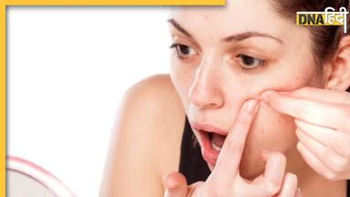 Acne Free, ग्लोइंग स्किन के लिए गुलाब जल के साथ मिलाकर लगाएं ये एक चीज, हफ्ते भर में दिखने लगेगा असर