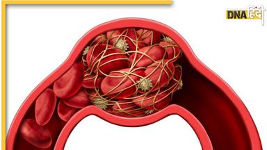 Blood Clotting Dangerous Sign: ये 4 संकेत बताते हैं फेफड़ों तक पहुंच सकती है ब्लड में बन रही क्लॉटिंग