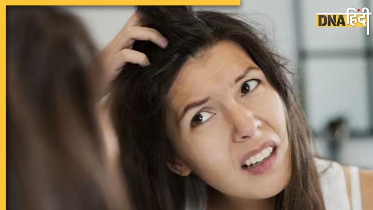 Scalp Psoriasis Treatment: इन 5 चीजों से चुटकियों में दूर होगी स्कैल्प सोरायसिस की प्रॉब्लम, खुजली और सिर में जमी पपड़ी से मिलेगा छुटकारा