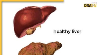 Liver Cirrhosis: लिवर सिरोसिस के हैं ये 7 चेतावनी संकेत जिन्हें नज़रअंदाज़ करना यानी मौत को दावत देना है