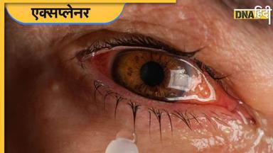 Eye Flu के बारे में सबकुछ जो आप जानना चाहते हैं