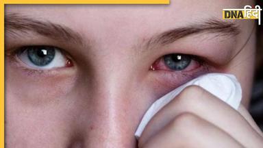 आंखों में है जलन और खुजली तो तुरंत करें ये काम, एक्सपर्ट्स ने Eye Flu के लिए बताया कारगर