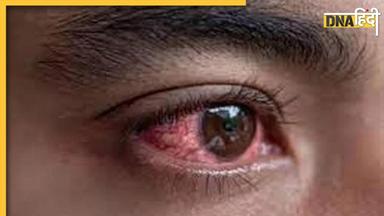 Eye Flu Treatment: सिर्फ 24 घंटे में ठीक सकता है आई फ्लू, इन 2 तरीकों से दूर होगा आंखों का संक्रमण