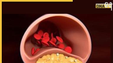 Cholesterol Alert: खून में वसा जमाने में ऑयल से भी ज्यादा खतरनाक है ये एक सफेद चीज, नसे वसा से रहेंगी जकड़ी