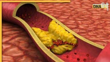 Mistakes In Cholesterol: खून में गंदा कोलेस्ट्रॉल बढ़ा सकती हैं ये 5 गलतियां, नसों में वसा की जमने लगेगी परत