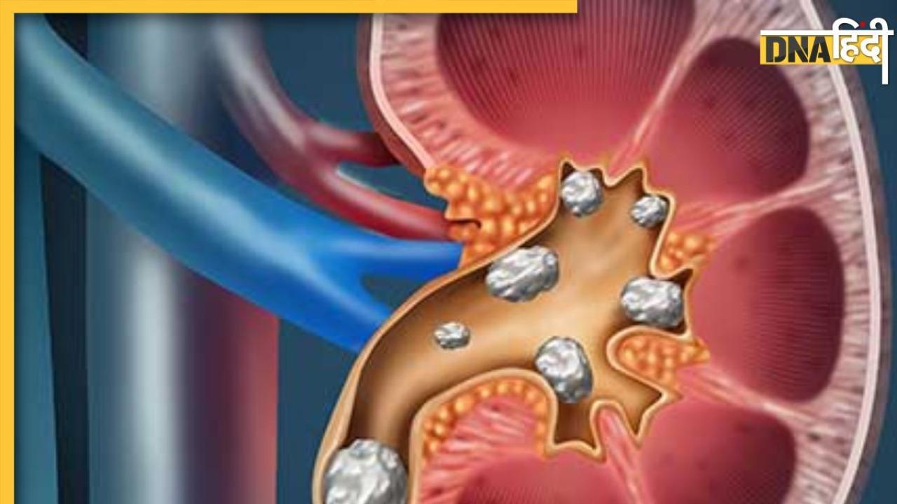 पथरी को गलाकर बाहर कर देगा इस फल का पानी, किडनी में जमा गंदगी और प्यूरीन को करता है फ्लशआउट