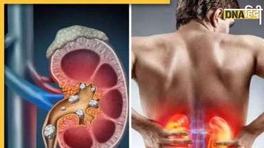 Kidney Stones: किडनी में पथरी से हैं परेशान तो डाइट में शामिल कर लें ये फल, बिना ऑपरेशन बाहर हो जाएगा स्टोन