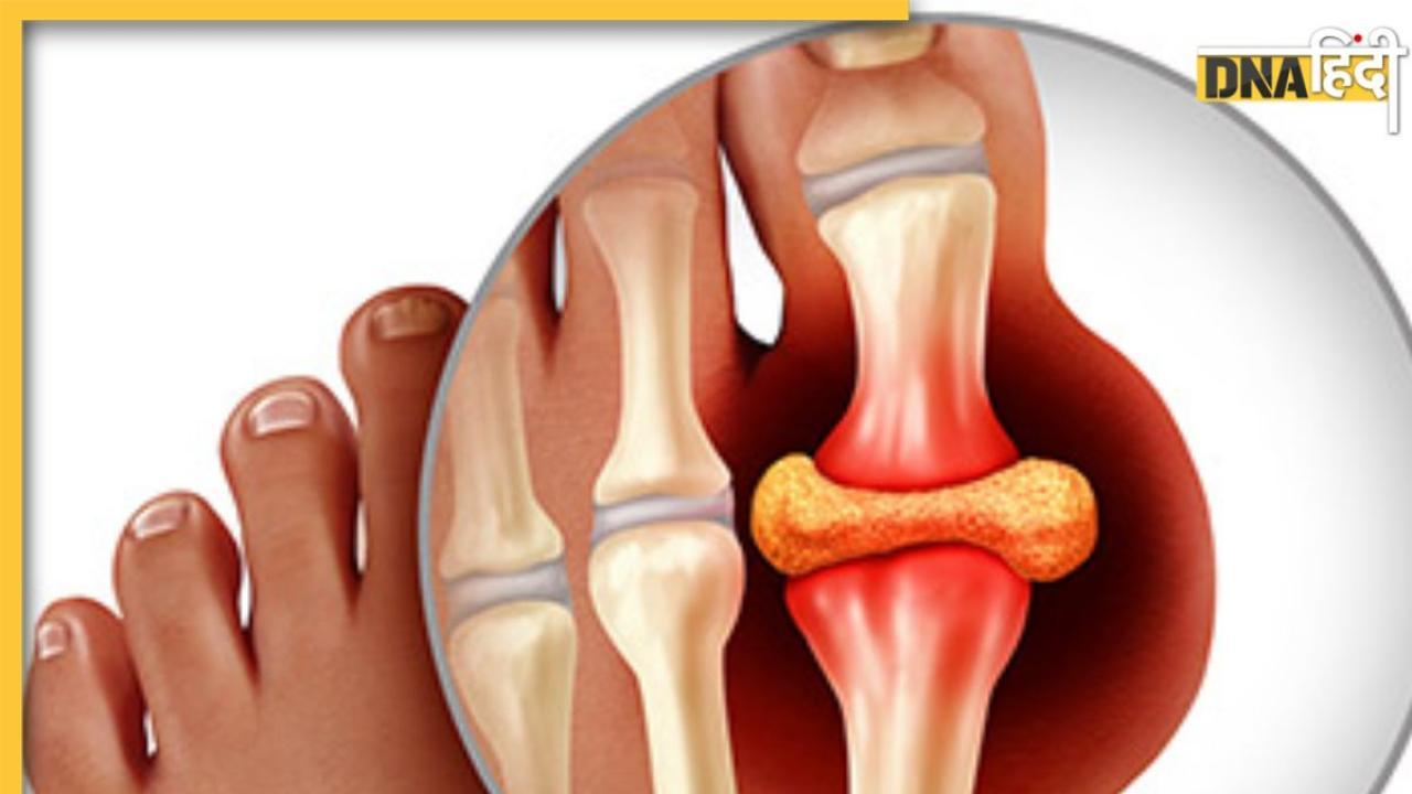 Uric Acid Remedy: खून में जमा यूरिक एसिड शरीर से बाहर निकाल देंगे ये 2 मसाले, इस तरह करे इस्तेमाल 