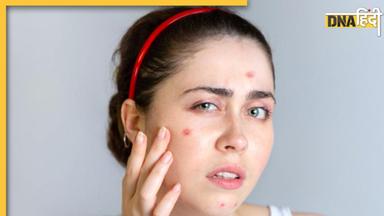 Skin Care Tips: वेडिंग सीजन में इन 5 टिप्स से तुरंत चमक जाएगा चेहरा, गायब होंगे मुहांसे और दाग-धब्बे