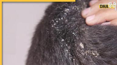 Dandruff Remedies: बालों की रूसी ने कर रखा है परेशान? इस रामबाण नुस्खे से दूर होगी डैंड्रफ की समस्या