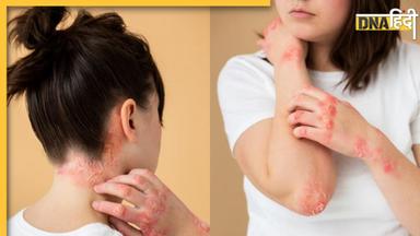 Psoriasis Treatment: चर्म रोग सोरायसिस का रामबाण इलाज है ये औषधीय पौधा, इन बीमारियों में दवा का करता है काम