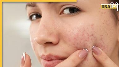 Pimples Remedies: खूबसूरती को खराब कर रहे हैं चेहरे के छोटे-छोटे दाने, इन घरेलू उपायों से दूर होगी समस्या