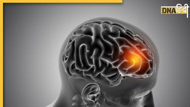 Stroke Symptoms: क्या है F.A.S.T फॉर्मूला, स्ट्रोक को पहचानने में कैसे करता है मदद? 