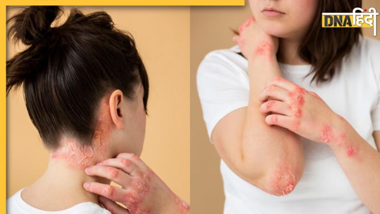 Dermatomyositis क्या है जिससे दंगल फेम सुहानी थीं पीड़ित? शरीर में सूजन-लाल चकत्ते जैसे दिखते हैं संकेत