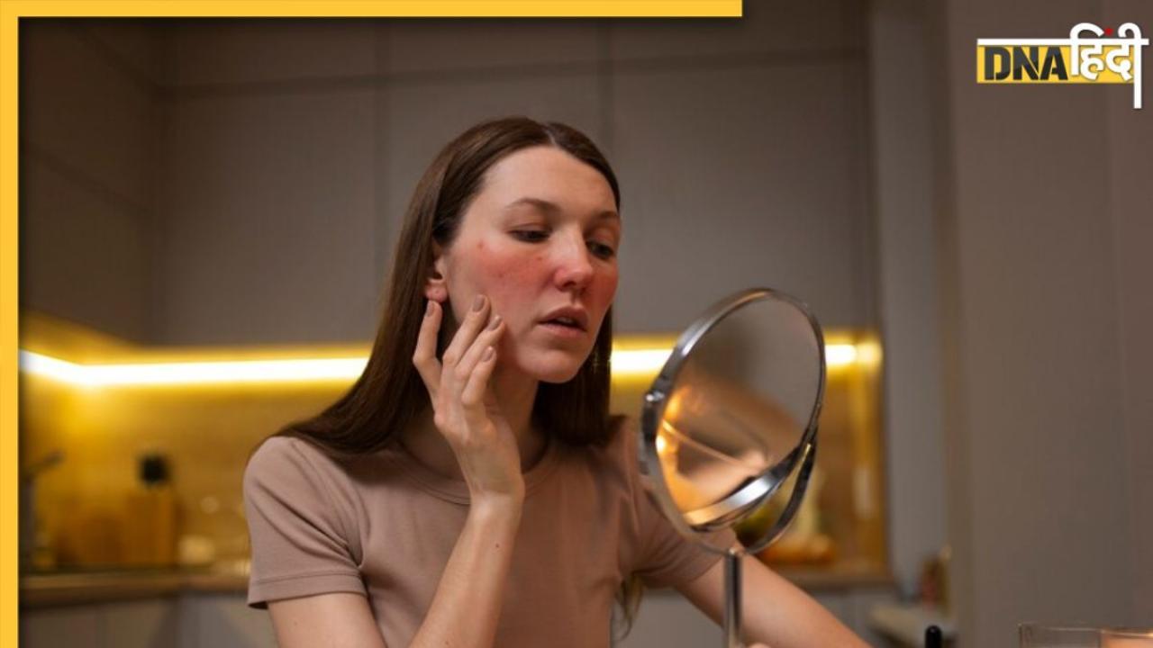 Acne या Pimples नहीं, चेहरे पर निकलने वाले लाल दाने हो सकते हैं इस गंभीर बीमारी के संकेत  