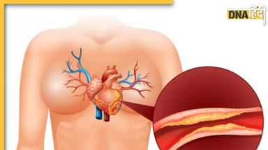 High Cholesterol के इन शुरूआती लक्षणों को न करें अनदेखा, वरना हार्ट अटैक-स्ट्रोक से जा सकती है जान 