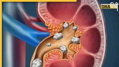 शरीर में दिखने वाले ये लक्षण हो सकते हैं Kidney Stone के शुरुआती लक्षण, दिखते ही कराएं जांच 