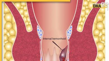 Bloody Piles Treatment:  खूनी बवासीर की समस्या को दूर करेगी किचन में मौजूद ये पीली चीज, बस ऐसे करें इस्तेमाल