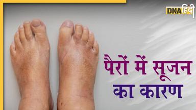 Swelling in Feet: पैर या तलवे में सूजन इन गंभीर बीमारियों का शुरुआती संकेत, जरा सी लापरवाही जान पर पड़ेगी भारी