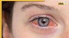 मानसून में बढ़ा Eye Infection का खतरा, इस तरह करें बचाव 
