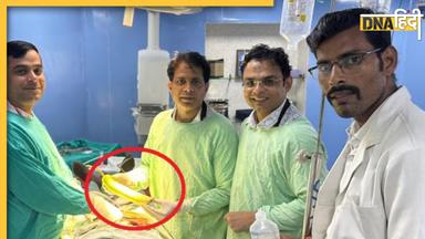 इस 'नाजुक' जगह से निकाली गई 16 इंच की लौकी, फट गईं अंदर की नसें के अलावा Doctors तक की आंखें