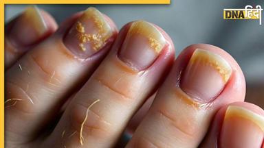 हाथ-पैर के नाखूनों में ये बदलाव Fungal Nail Infection का हैं संकेत, न करें इग्नोर