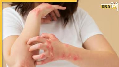 Remedies For Ringworm: बरसात के मौसम में परेशान कर रही है दाद, खाज और खुजली की समस्या, इन घरेलू उपायों से मिलेगा आराम