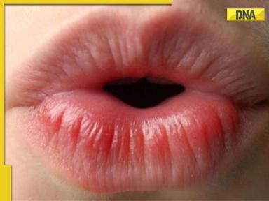 What is lip cancer? Know signs, causes, diagnosis and treatment options