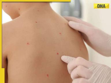 What is the difference between Monkeypox and Chickenpox?