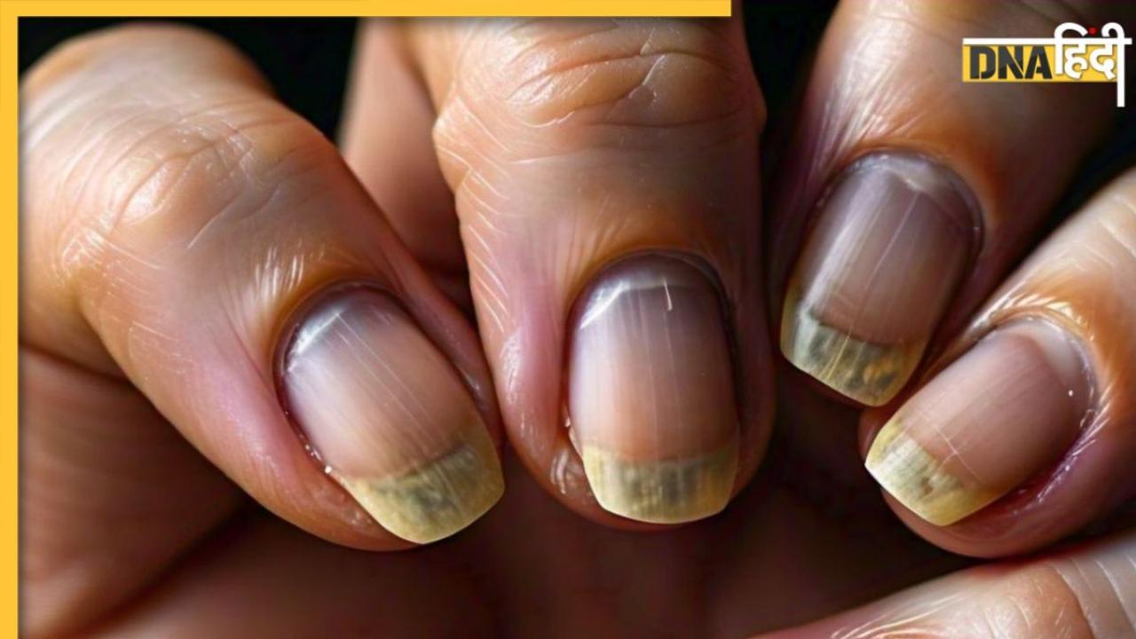 Nail Abnormalities: गंभीर बीमारियों की ओर इशारा करते हैं नाखून में दिखने वाले ये लक्षण, तुरंत कराएं जांच