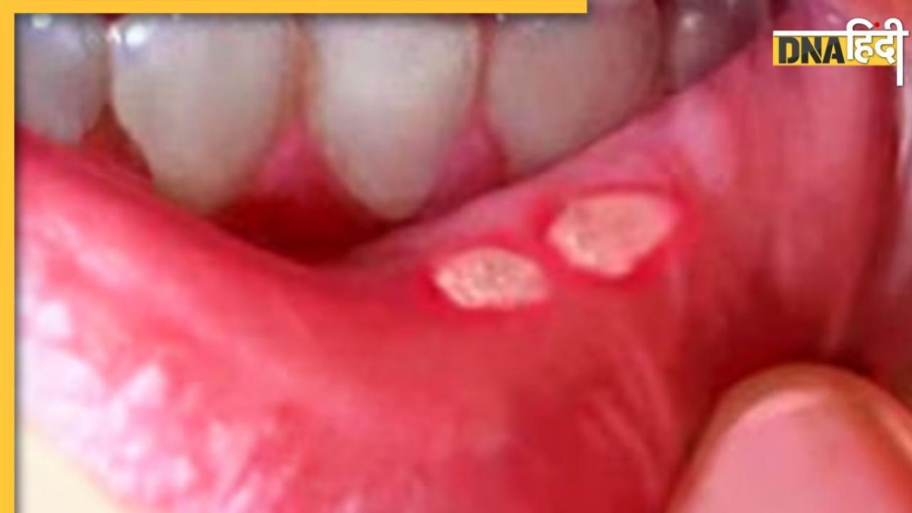 Mouth Ulcer Home Remedies: मुंह के छालों से हैं परेशान तो आजमा लें ये घरेलू उपाय, झटपट मिल जाएगा आराम