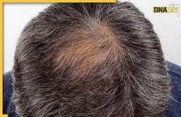 Hair Loss Remedy: ये 6 जड़ी-बूटियां गंजी हो चुकी खोपड़ी पर उगा देती हैं बाल, Hair Loss की है ये बेस्ट रेमेडी