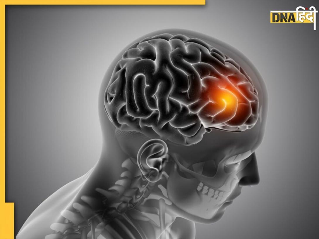 Stroke Symptoms: क्या है F.A.S.T फॉर्मूला, स्ट्रोक को पहचानने में कैसे करता है मदद? 