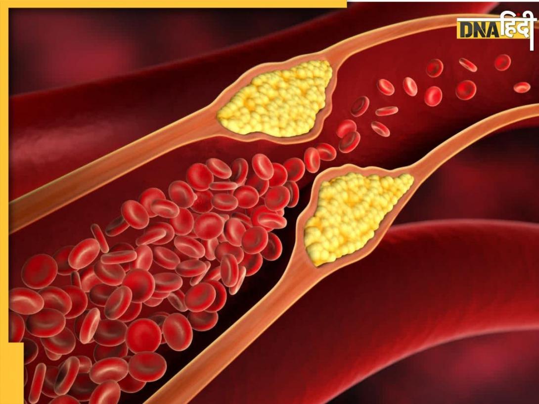 नसों में जमे Bad cholesterol को मोम की तरह पिघला देगी इस पेड़ की छाल, जानिए इसके अन्य लाभ