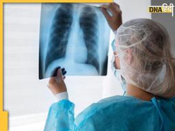 Lung Cancer Signs: बॉडी में दिखने वाले ये लक्षण देते हैं लंग्स कैंसर का संकेत, शुरुआत का पता लगते ही किया जा सकता है कंट्रोल